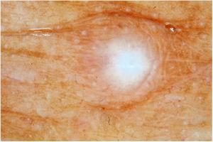 Dermatoscopia do hansenoma: área nacarada cicatricial no centro da lesão.