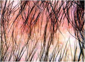 Dermatoscopia das áreas de alopecia não cicatricial sifilítica. * Dermatoscópio DermLite modelo DL3, aumento 10×.