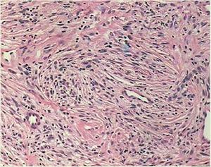 Histopatologia: proliferação fusocelular com padrão focalmente estoriforme. (Hematoxilina & eosina 100x).