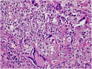 Paracoccidioidomicose: infiltrado inflamatório crônico granulomatoso com presença de células fúngicas no interior do citoplasma de células gigantes e macrofágicas (Hematoxilina & eosina, 400×).