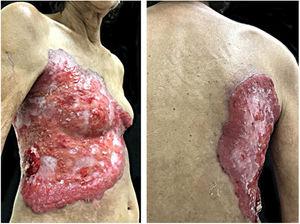 Tórax e dorso à direita: úlcera extensa com bordas eritêmato‐violáceas, infiltradas e irregulares. Face lateral do tórax: tumoração de aspecto vegetante, eritematosa e ulcerada.