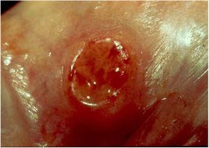 Lesão ulcerada com fundo granuloso e sangramento localizado no sulco bálano‐prepucial.