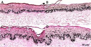 Fragmentos histológicos de pele corados pelo Fontana‐Masson de melasma facial e pele normal adjacente antes e após irradiação com 40J/cm2 luz visível, revelam aumento da densidade de melanina basal entre as amostras. (A), pele normal adjacente pré irradiação LV; (B), pele normal adjacente pós‐irradiação LV; (C), pele com melasma pré‐irradiação LV; (D), pele com melasma pós‐irradiação com LV.