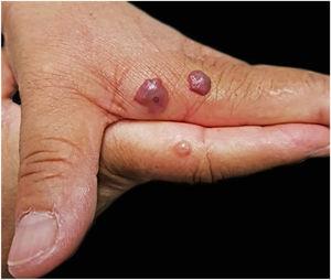 Bolhas nas mãos da Paciente 2, que identificou as picadas como de mutucas. Algumas têm conteúdo hemorrágico e um ponto central onde ocorreu a picada. Fotografia: Sílvia Mitiko Nishima.