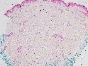 Histopatologia, de início erroneamente interpretada como esclerodermia (Hematoxilina & eosina, 100×).