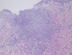 Histopatologia mostrando degeneração basofílica das fibras colágenas e numerosos restos nucleares na derme superior (Hematoxilina & eosina, 100×).