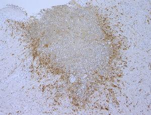 Imunomarcação com CD68 mostrando histiócitos formando paliçada ao redor das fibras de colágeno degeneradas (100×).