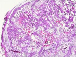 Visão panorâmica de proliferação lobular dérmica composta predominantemente de células sebáceas maduras (Hematoxilina & eosina, 40×).