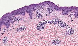 Espongiose leve, exocitose de linfócitos, edema da derme papilar e infiltrado linfo‐histiocitário perivascular com aspecto em “manguito”. Nenhum eosinófilo foi observado (Hematoxilina & eosina, 100×).