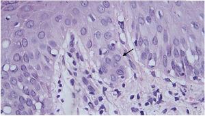 Epiderme apresentando área com células exibindo pálida inclusão nuclear (seta), em meio à espongiose. Adjacente, interface com permeação linfocitária e discreto extravasamento de hemácias na derme (Hematoxilina & eosina, 40×).