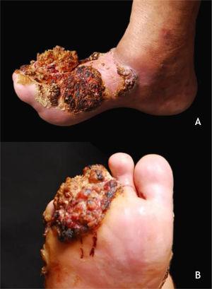 A e B, Carcinoma verrucoso, grande tumoração na região do antepé, multilobulada, com áreas verrucosas, atingindo dorso do pé (A) e planta (B). Arquivo: Serviço de Dermatologia do HC‐UFMG/EBSERH.