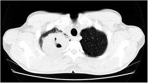 Tomografia computadorizada do tórax evidenciando cavitação com parede espessa no lobo superior direito em meio a consolidações em outras áreas pulmonares.