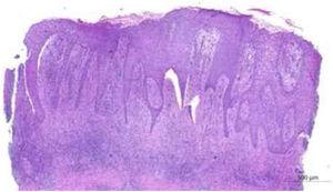 Exame anatomopatológico: cordões epiteliais anastomosantes de células cuboides formando trabéculas em estroma fibroso que partem da epiderme à derme profunda (Hematoxilina & eosina, 20×).