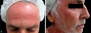 (A e B), Pápulas e placas eritematosas com descamação superficial na face.