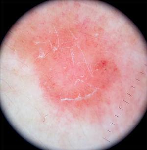 Dermatoscopia mostrando fundo rosa com vasos puntiformes e glomerulares e fina descamação branca.