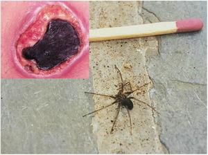 Úlcera cutânea com formação de escara necrótica em área de acidente loxoscélico (> 96 horas). Exemplar de animal adulto da “aranha marrom” (Loxosceles sp.).