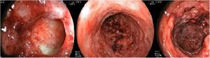 Colonoscopia mostrando processo inflamatório ulcerado intenso em cólon e íleo.