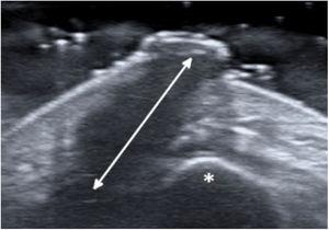 Exame de ultrassonografia revela uma ampla faixa hipoecoica (seta) que se estende pelo tecido subcutâneo até o osso mandibular (asterisco).