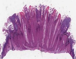 Verruga vulgar apresentando hiperceratose, papilomatose, acantose e cones epiteliais com eixo em direção ao centro da lesão (Hematoxilina & eosina, 40×).