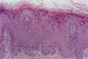 Verruga plana em que se observa hiperceratose em cesta, hipergranulose, acantose com fusão de cones epiteliais e coilocitose no terço superior da epiderme (Hematoxilina & eosina, 100×).