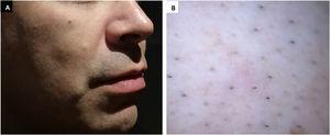 (A), Pápula normocrômica na região bucinadora direita. (B), Imagem dermatoscópica polarizada mostrando aspectos não característicos.