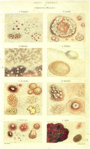 Ilustrações das doenças dermatológicas por Robert Willan (1808). Fonte: On Cutaneous Diseases.49