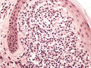 Detalhe do infiltrado linfo‐histiocitário em uma papila dérmica aumentada (Hematoxilina & eosina, 200×).
