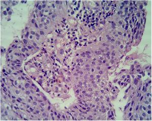 Lesão peniana assintomática nodular eritematosa: apresentação incomum de carcinoma espinocelular. Células atípicas com empilhamento nuclear, perda de polaridade, falta de maturação na superfície epitelial, alta relação N:C, núcleos hipercromáticos e múltiplas figuras mitóticas. Alteração focal de células claras é observada na junção do epitélio atípico e epitélio normal (Hematoxilina & eosina, 40×).