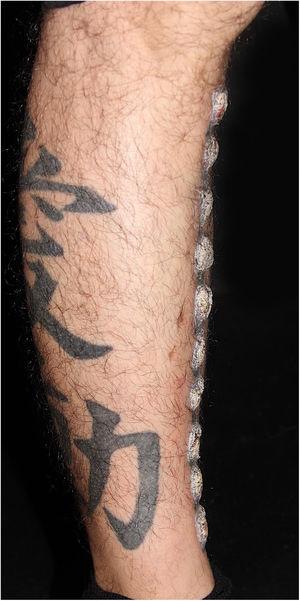 Visão lateral das verrucosidades. Note uma tatuagem em preto com aspecto normal na panturrilha.