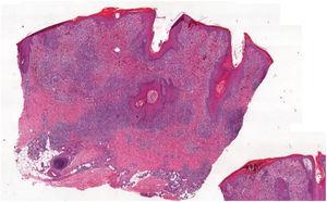 Aspecto histopatológico da biópsia de área verrucosa: acantose, inflamação superficial e profunda, dermatite de interface e agressão folicular (Hematoxilina & eosina, 40×).