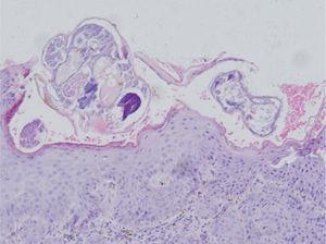 A biópsia de pele da glande mostrou hiperqueratose, acantose da camada de Malpighii. O estrato córneo revelou múltiplas tocas subcórneas contendo larvas e ovos de Sarcoptes scabiei. A derme apresentava infiltrado de células inflamatórias, predominantemente eosinófilos e linfócitos (coloração Hematoxilina & eosina, 20×).
