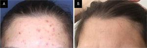 Caso 2. (A) Pápulas eritematosas e escoriadas e máculas hiperpigmentadas na região frontal de paciente com acne escoriada. (B) Melhora clínica completa após seis semanas de tratamento com N‐acetilcisteína.