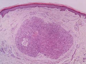 Leiomiossarcoma dérmico – pequeno aumento. Lesão nodular localizada na derme, não encapsulada e sem conexão com a epiderme adjacente (Hematoxilina & eosina, 40×).