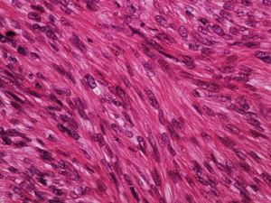 Leiomiossarcoma dérmico – grande aumento. As células são fusiformes, com núcleos alongados e extremidades rombas, nucléolo discreto e citoplasma eosinofílico fibrilar (Hematoxilina & eosina, 400×).
