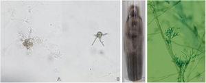 Exames micológicos de um caso de cromoblastomicose. (A e B), Exame micológico direto (KOH 20%, 200×) evidenciando em dois campos distintos a “aranha de Borelli”. (C e D), Cultivo fúngico com morfologia macromicroscópica compatível com Fonsecaea pedrosoi.