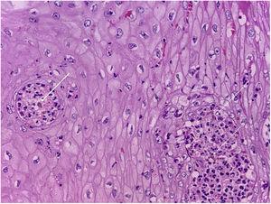 Exame histopatológico de cromoblastomicose (Hematoxilina & eosina, 40×). Seta contínua: corpúsculo muriforme (CM) no centro de um micoabcesso intraepidérmico, patognomônico da doença. Setas tracejadas: identificação de hifas demáceas septadas.