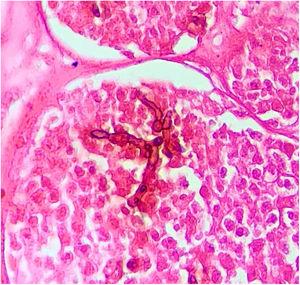 A ‐ Exame histopatológico de cromoblastomicose evidenciando corpúsculos muriformes associados a hifas demáceas, “Aranha de Borelli” (Fontana Masson, 1.000×).