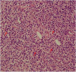 Plasmócitos (setas vermelhas) na derme em biópsia de pele de uma úlcera de leishmaniose cutânea (400×).