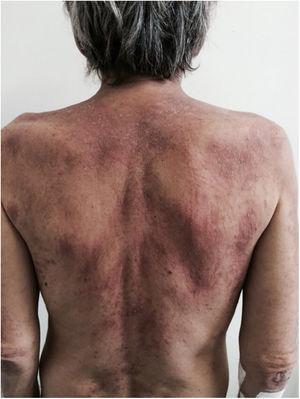 Doença de Still do adulto – lesões flageladas. Máculas lineares de aspecto flagelado da doença de Still do adulto.