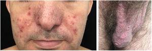 Doença de Behçet. Vesico‐pústulas acneiformes na face e úlceras na bolsa escrotal (dolorosas).