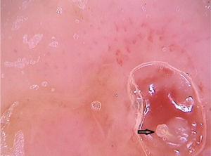 Imagem dermatoscópica de miíase furunculoide demonstrando porção anterior de larva de Dermatobia hominis (Fotofinder, magnitude original 20×). Fonte: Acervo Hospital de Clínicas de Porto Alegre.