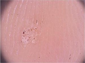 Imagem dermatoscópica de verruga plantar com hiperqueratose e vasos trombosados. (Fotofinder, magnitude original 20×). Fonte: Acervo pessoal dos autores.