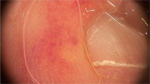 Imagem dermatoscópica com áreas eritemato‐violáceas em paciente com eritema pernio detectado durante a pandemia de COVID‐19 (Fotofinder, magnitude original 20×). Fonte: Acervo pessoal dos autores.