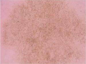 Imagem dermatoscópica de tinea nigra demonstrando estruturas enegrecidas lineares difusas (Fotofinder, magnitude original 20×). Fonte: Acervo do Hospital de Clínicas de Porto Alegre.