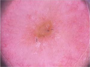 Imagem dermatoscópica de esporotricose demonstrando eritema e áreas centrais de erosão (Fotofinder, magnitude original 20×) Fonte: Acervo do Hospital de Clínicas de Porto Alegre.