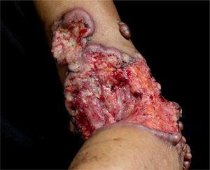 Lesão tumoral ulcerada, com exposição de tendão, sangrante, com bordas elevadas e presença de nódulos queloidiformes.