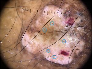 Imagem dermatoscópica de uma lesão nodular queloidiforme do membro inferior (dermatoscopia não polarizada, 10×). Vários pontos pretos (círculos azuis).