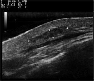 Ultrassonografia transversal (18MHz) do mixoma subcutâneo, mostrando uma massa mal definida, alongada, heterogênea e hipoecoica localizada na derme profunda e hipoderme.