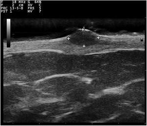 Ultrassonografia transversal (18MHz) de mixoma superficial, mostrando lesão bem definida, redonda, homogênea e hipoecoica localizada na derme superficial com elevação da epiderme.