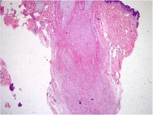 Microfotografia (Hematoxilina & eosina, 40×) do mixoma superficial mostra estruturas anexiais foliculares ao lado de neoplasia mixoide hipocelular e proliferação vascular.